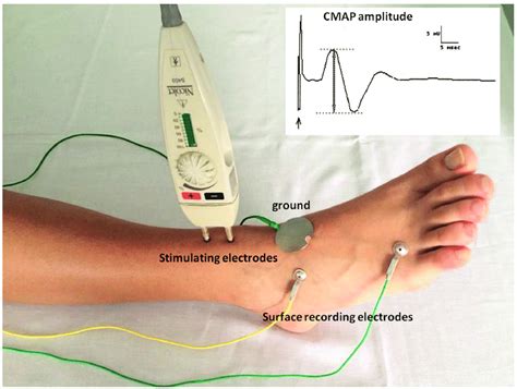 electrodiagnostic testing for peroneal neuropathy